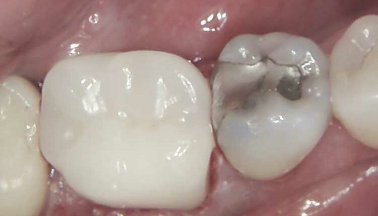 1121-did-endodontic-therapy-5