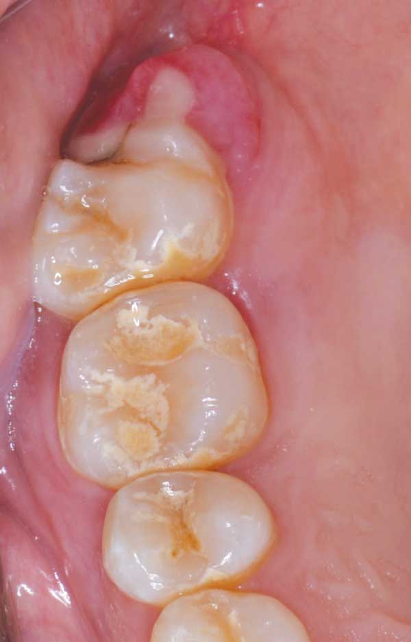 ossifying fibroma oral