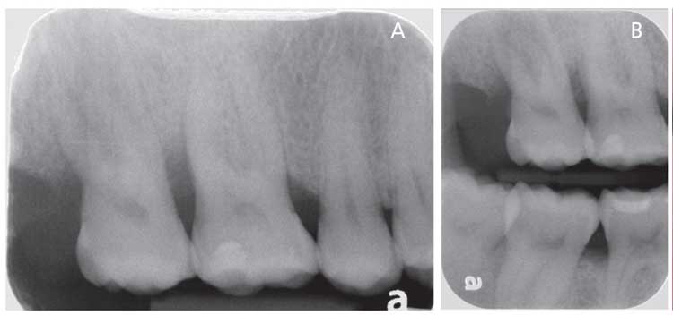 peripheres ossifizierendes Fibrom