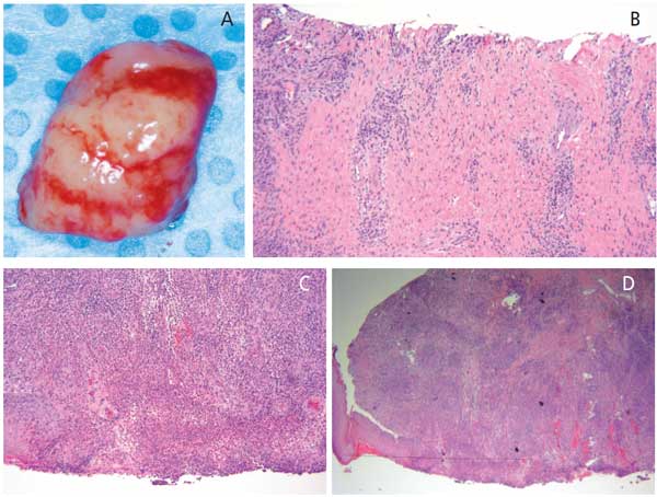 peripheral ossifying fibroma histology