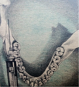 FIGURE 3. Occlusal view of the approach for the Vazirani-Akinosi method.