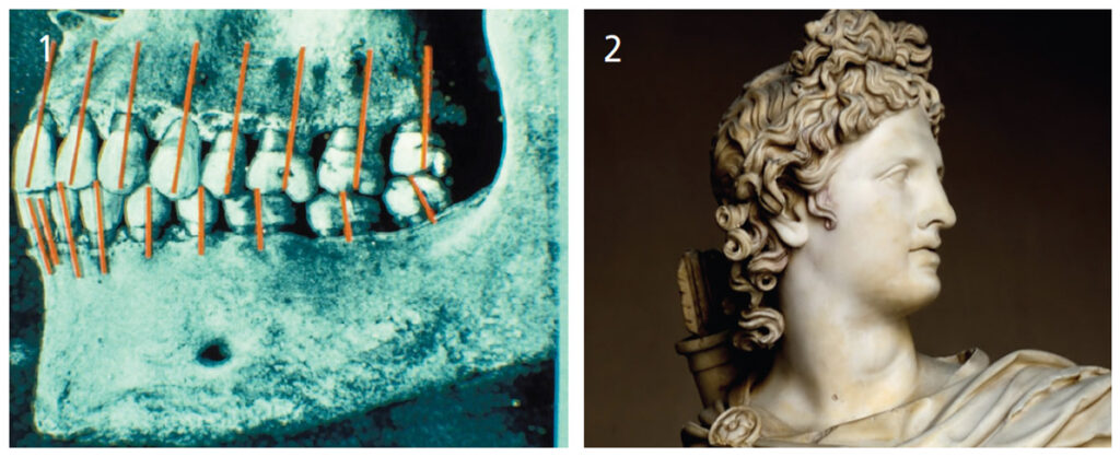 FIGURE 1 and FIGURE 2. Angle1 did not consider the issue of how to fit the dentition of his ideal occlusal model, Old Glory, an aboriginal skull, into a person not of aboriginal origin and with a completely different skeletal pattern.