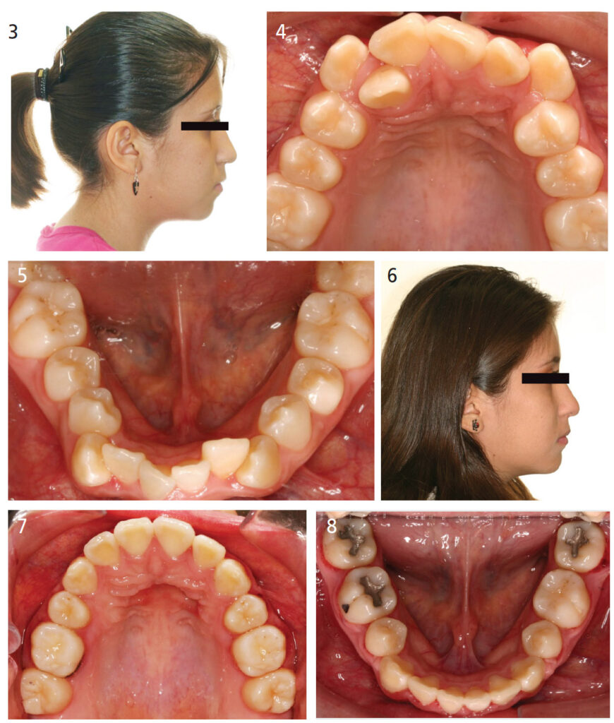 FIGURE 3 through FIGURE 8. This series demonstrates that it is indeed possible to perform extraction treatment with a tooth extracted in each dental quadrant and still have minimal impact on the fullness of the facial profile.