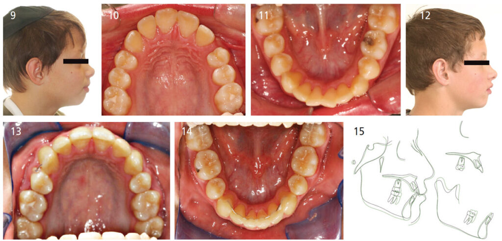 FIGURE 9 through FIGURE 15. This grouping demonstrates a four bicuspid extraction therapy where there is minimal cephalometric change in incisor position and, thus, no change in the profile as well.