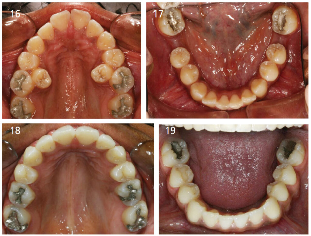 FIGURE 16 through FIGURE 19. These photos depict maxillary and mandibular arches that are both going to be missing teeth after treatment (second bicuspids in the maxillary arch, and first molars in the mandibular arch.) Removal of teeth in the maxillary arch actually increased the space available for the tongue.