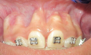 FIGURE 21. Teeth moved facially through the cortical plate in the anterior maxilla.