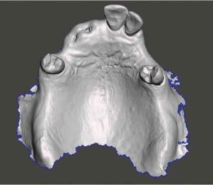 FIGURE 3. Three-dimensional solid model with maxillary teeth.