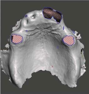 FIGURE 4. Virtual extraction of maxillary teeth from the digital model.