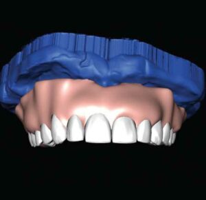 FIGURE 9. Digital gingiva is added in the software.