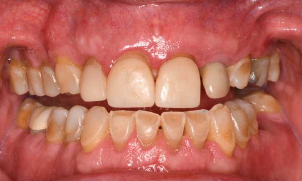 Decision-Making in Esthetic and Functional Crown Lengthening - Decisions in  Dentistry