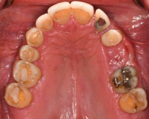 FIGURE 11. Postoperative maxillary occlusal view.