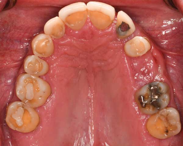 Decision-Making in Esthetic and Functional Crown Lengthening - Decisions in  Dentistry