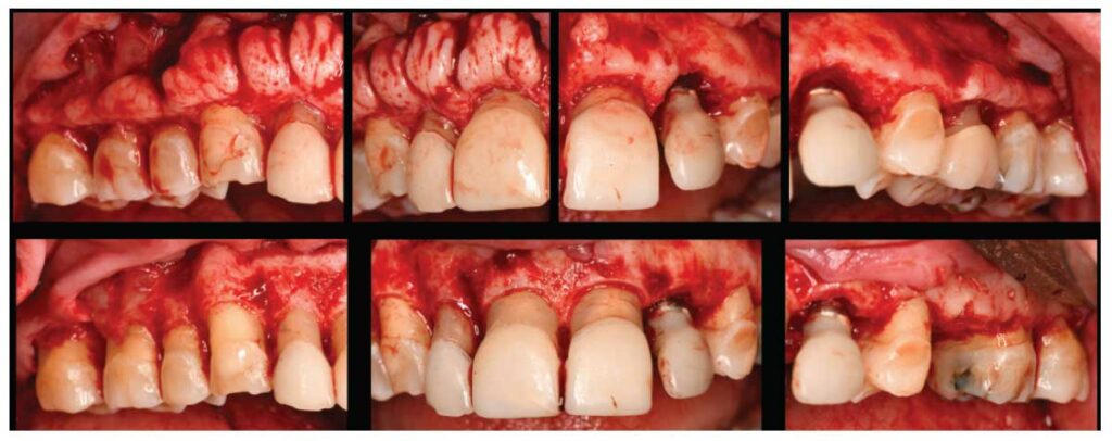 FIGURE 8. Pre- and post-osseous resection in the maxillary arch.