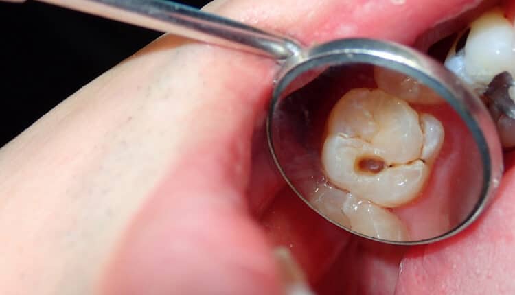 A dental tooth decay cavity found during routine dental examination check up using a dental mirror
