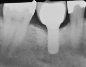 FIGURE 1. Implant restored two years prior to radiograph. Contact has opened and the patient now complains of food impaction.