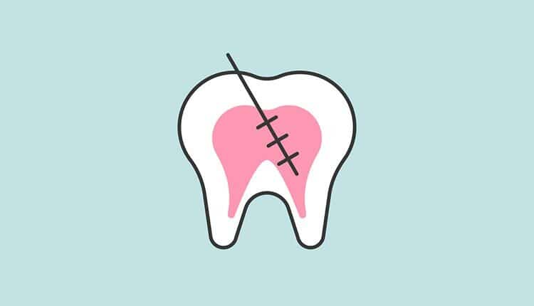 Tooth with root canal treatment or endodontic treatment, dental related icon, filled outline