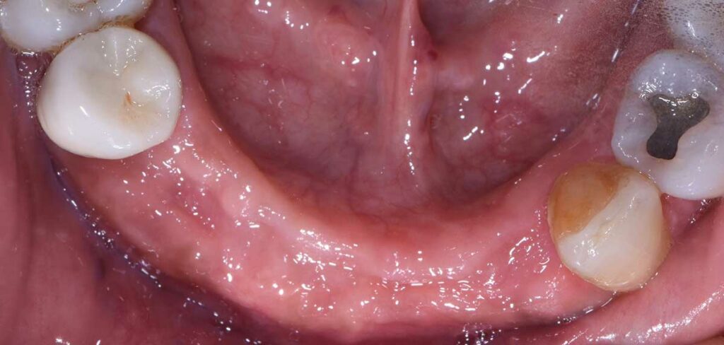 FIGURE 14. Postoperative healing at eight weeks.