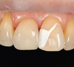 FIGURE 6. Final thin layer of OMNICHROMA.