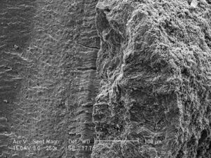 FIGURE 1. The right side of the image shows residual calculus on a root surface after scaling and root planing. A depression in the calculus in the upper right is shown at high magnification in Figure 2.