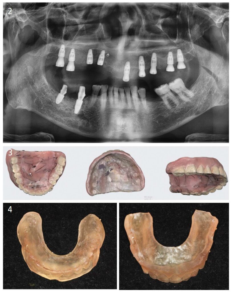 FIGURE 2 through FIGURE 4. Duplicate denture created using the Medit i700 intraoral scanner to scan the temporary complete denture used after maxillary implant placement. This duplicate denture was used to mount the maxillary and mandibular models. This reduced the number of visits required for wax rim production and acquisition of information concerning the jaw relationship.