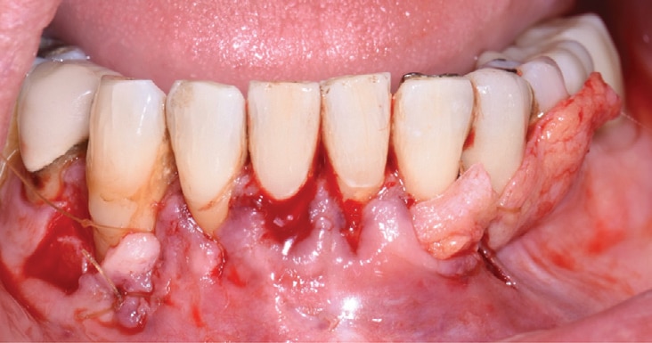 Gingival Recession Fig Decisions In Dentistry