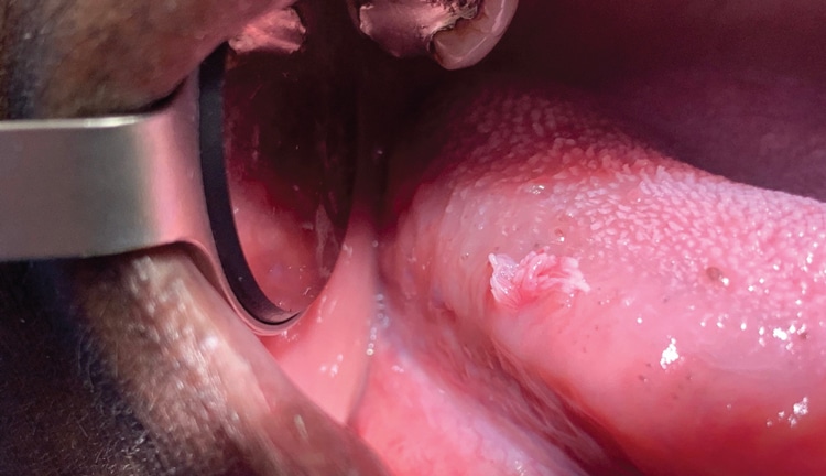 nasal papilloma treatment