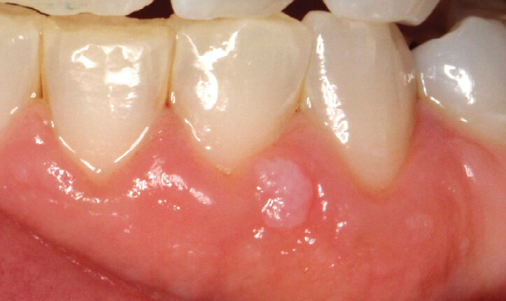 hn-lesions-fig-2