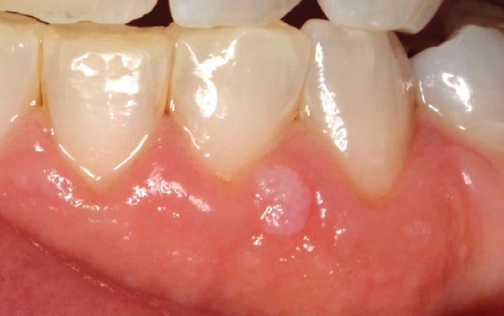 Intraoral verruca vulgaris, HPV-Related Papillary Lesions of the Oral ...