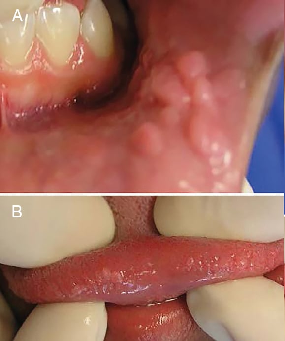 hpv on lips