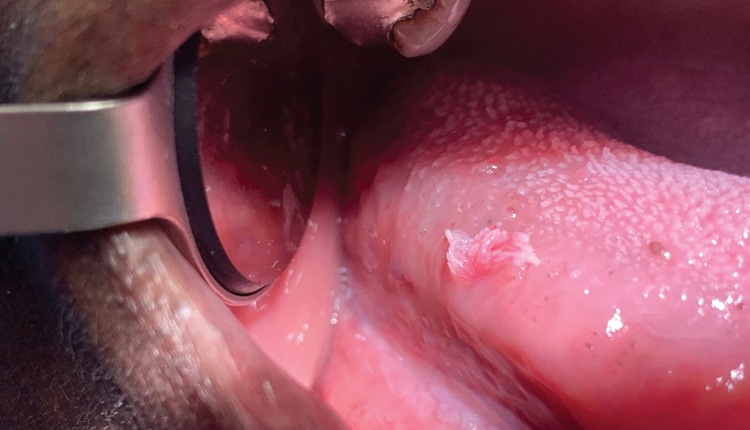 HPV Treatment with Electrocautery