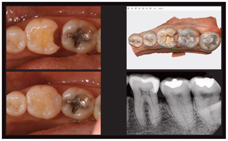 Digital Dentistry Begins With Intraoral Scanning - Decisions in Dentistry