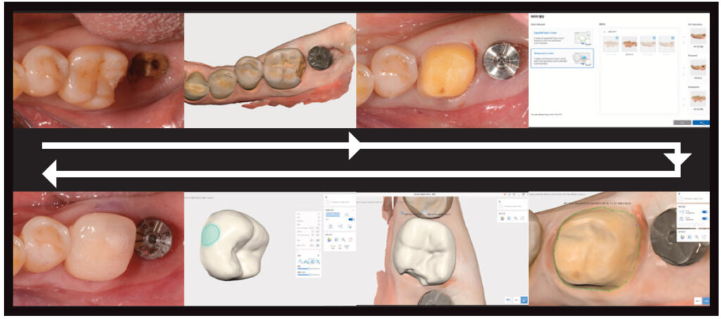 FIGURE 9. Temporary restoration with Medit Temporaries.