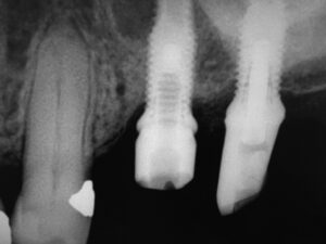 FIGURE 1. Remaining implant screw fragment.