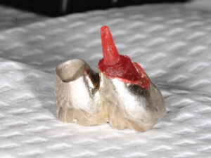 FIGURE 2. Pattern resin of the post/abutment retrofitted to the existing crown.