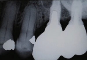FIGURE 3. Final cast post/abutment cemented in place with respective crowns.
