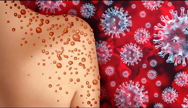 Monkeypox Virus Outbreak as a contagious infection as blisters and leisons on the skin representing transmission of an infected person with 3D illustration elements.