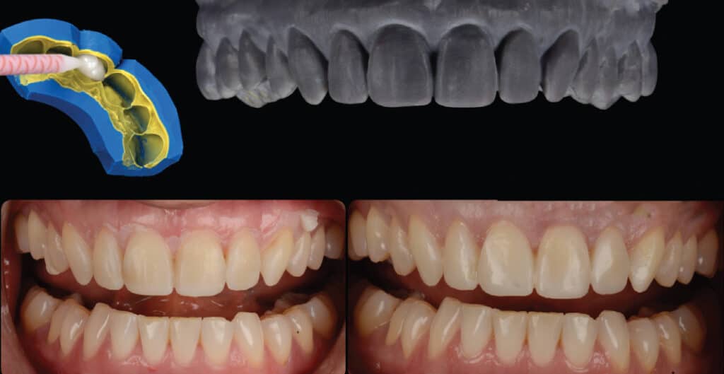 FIGURE 4. The 3D-printed solid cast can be used as a mock-up using a silicone index.