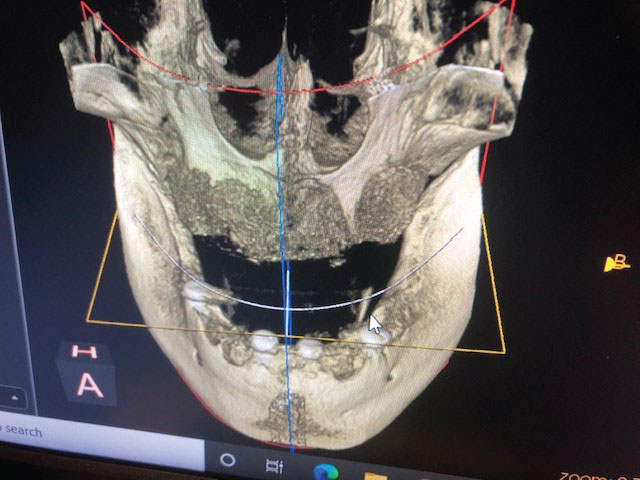 full-mouth-restoration-fig-9 - Decisions in Dentistry