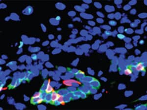 Head and neck cancer stem cells (red) expressing the CD276 gene (green) are found in high proportions at the periphery of tumors; CD276 helps protect stem cells and interior tumor cells (blue) from the immune system’s cancer-fighting T cells.