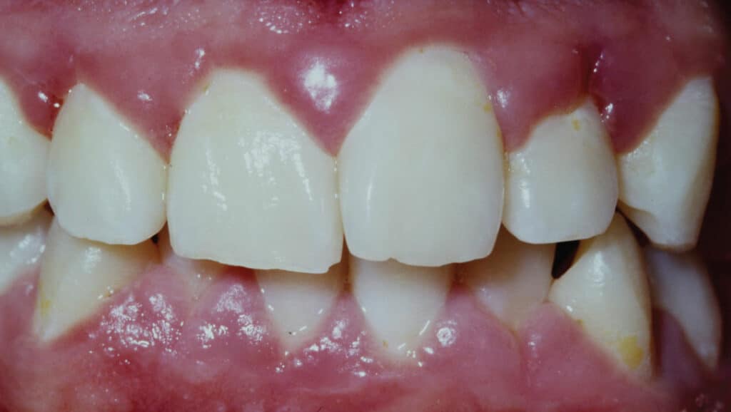 FIGURE 3. Periodontal inflammation resulting from chronic marijuana use.