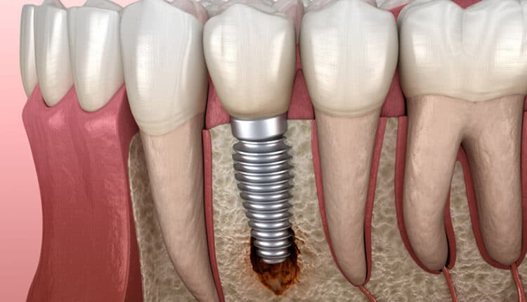 periimplantitis