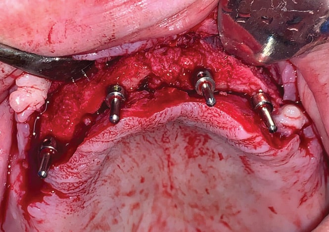 FIGURE 10. Maxillary osteotomies with guides.