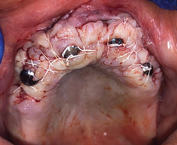 FIGURE 11. Maxillary surgical site closed.