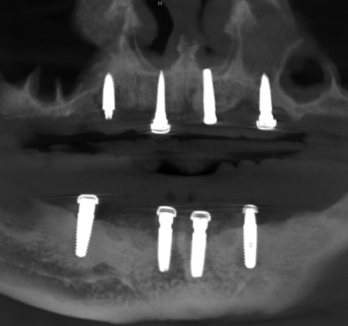 FIGURE 12. Image of all eight implants in place.