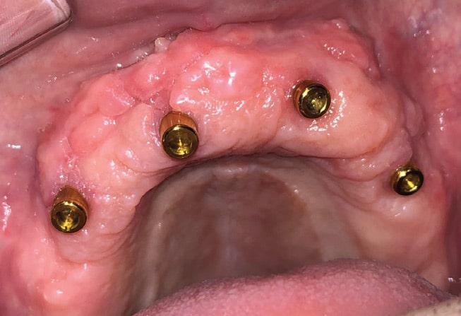 FIGURE 13A. Intraoral view of maxillary implants.