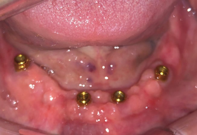 FIGURE 13B. Intraoral view of mandibular implants.