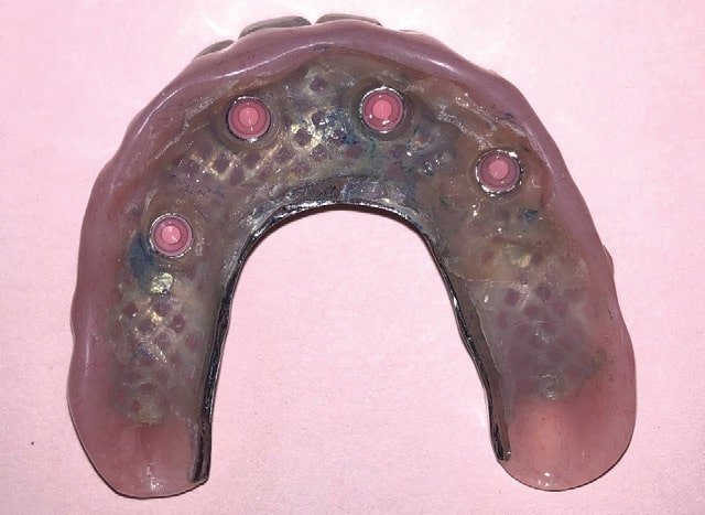 FIGURE 14A. Intaglio surface of the maxillary denture.