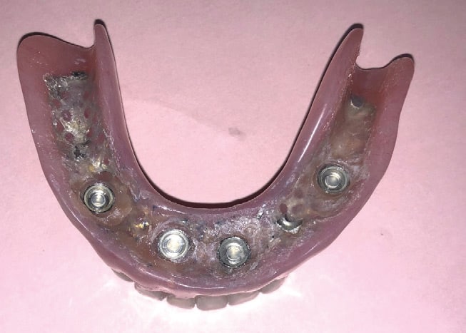 FIGURE 14B. Intaglio surface of the mandibular denture.