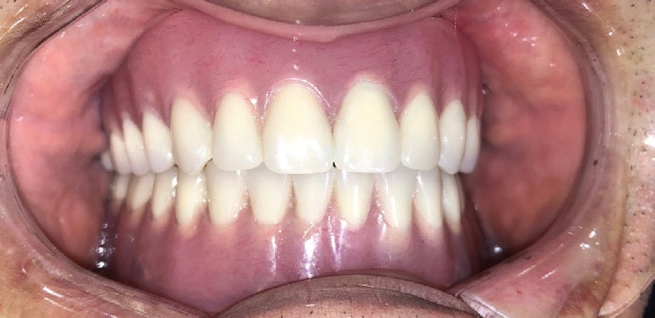 FIGURE 15A. Final implant-retained maxillary and mandibular dentures.