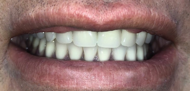 FIGURE 15B. Post-treatment view of implant-retained maxillary and mandibular dentures.